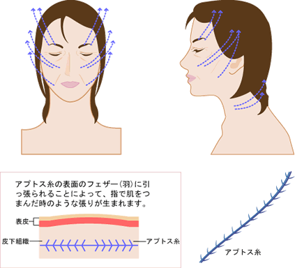フェザーリフト