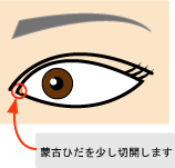 目頭切開法