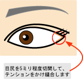 目尻切開法