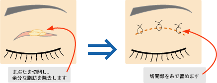 切開法